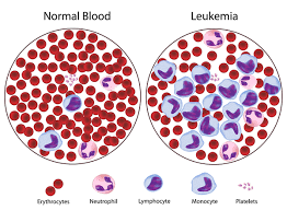 Congress 60's Finding: Opium Cures Different Types of Leukemia 