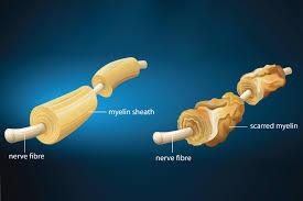 Research Square publishes: A short communication by Congress 60 on the effect of opium on MS (Multiple Mclerosis)  . 